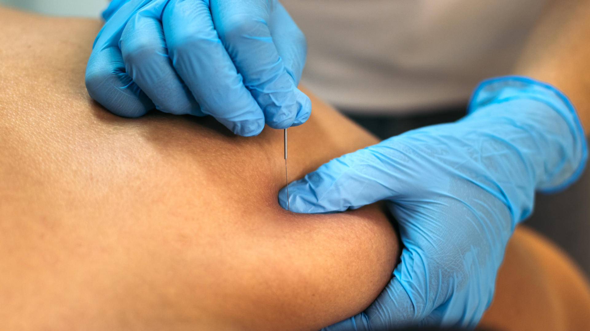 dry needling