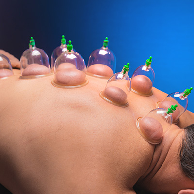 Cupping Therapy