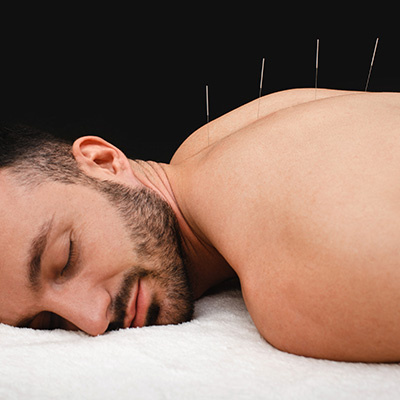 Dry Needling