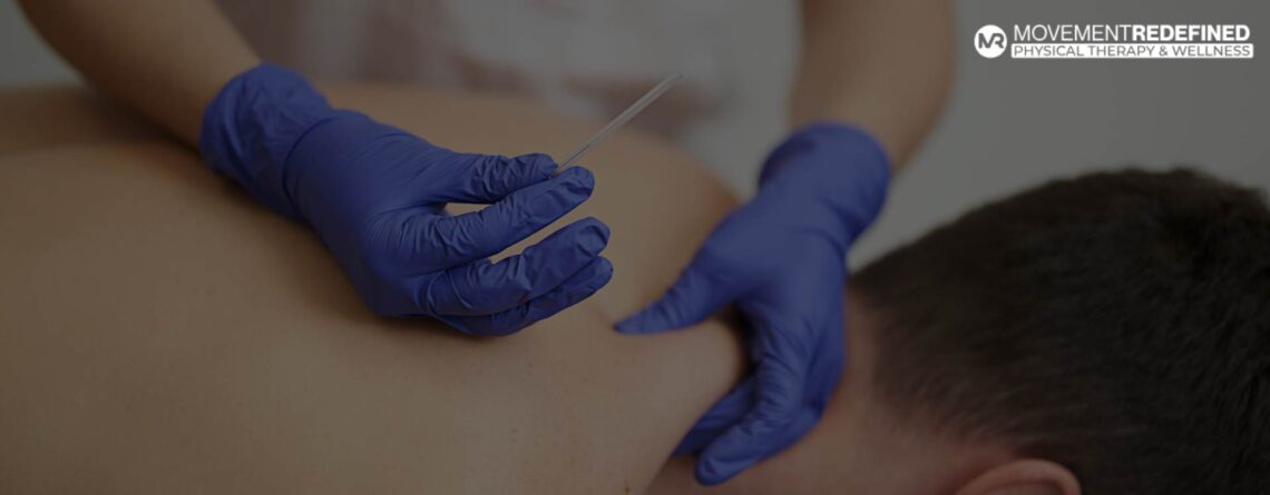 Discover the Benefits of Dry Needling at Movement Redefined